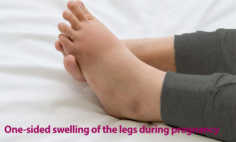 One-sided swelling of the legs during pregnancy