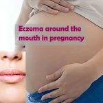 Eczema around the mouth in pregnancy