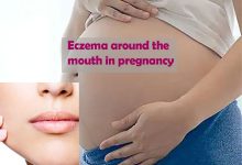 Eczema around the mouth in pregnancy