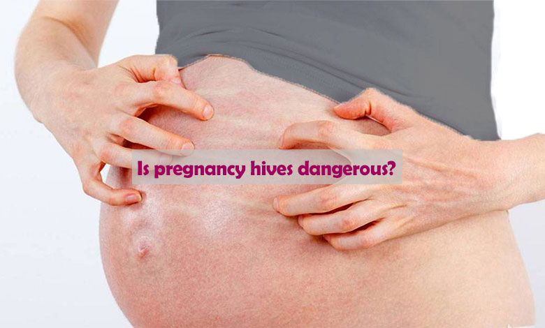 Is pregnancy hives dangerous?