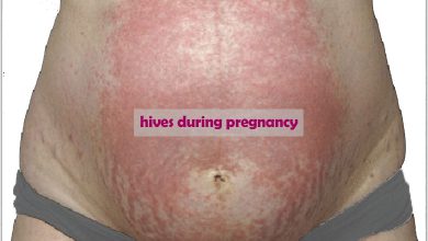 What is the symptom of skin hives during pregnancy and is it dangerous?