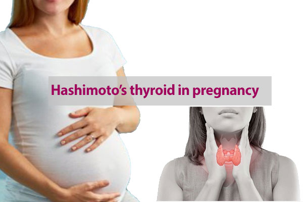 Hashimoto’s thyroid in pregnancy