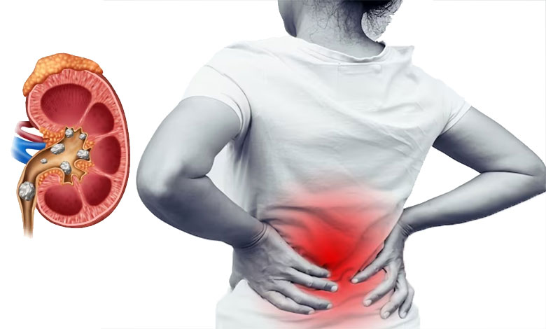 Kidney pain is caused by infection or kidney stones