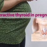 Overactive thyroid in pregnancy