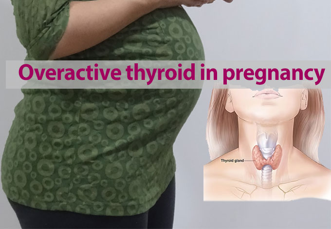 Overactive thyroid in pregnancy
