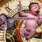 Overdue pregnancy
