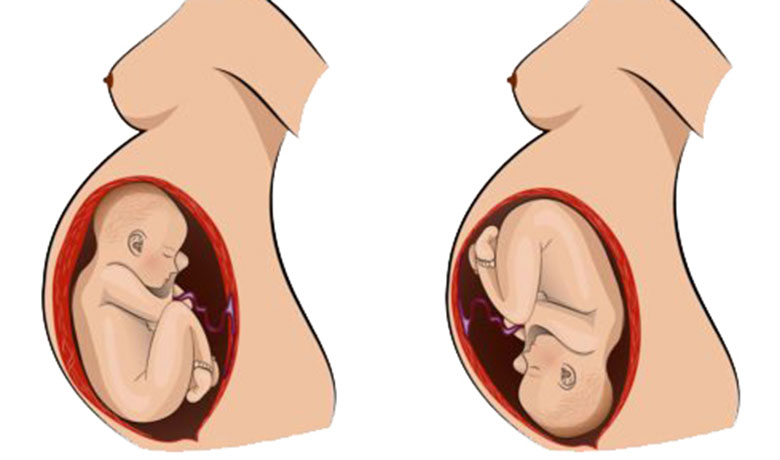 Is the breech position normal?