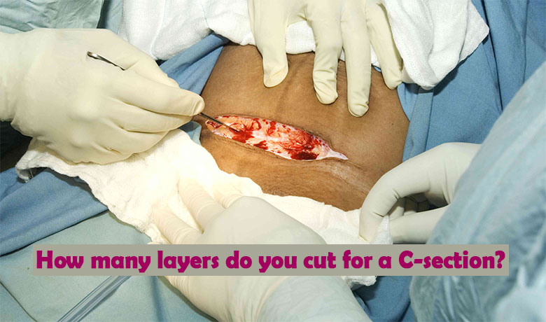 How many layers do you cut for a C-section?