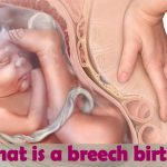 Breech Baby: Causes, Complications, Turning & Delivery