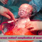 what is cesarean section? complication of cesarean section