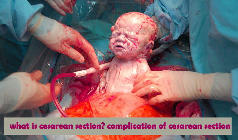 what is cesarean section? complication of cesarean section