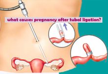 what causes pregnancy after tubal ligation?