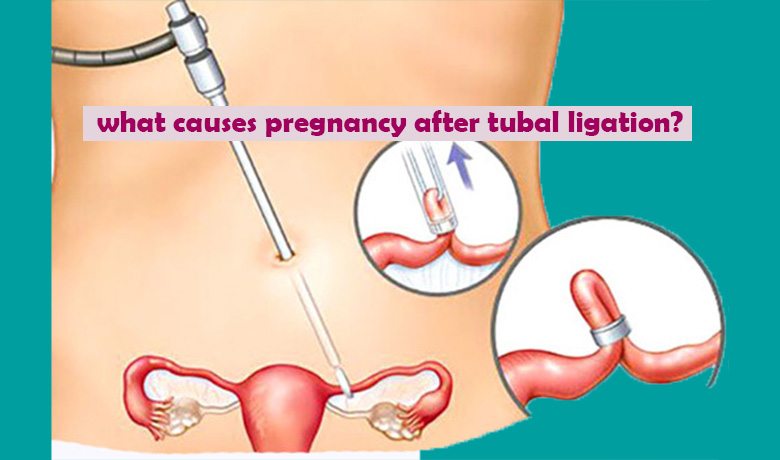 what causes pregnancy after tubal ligation?